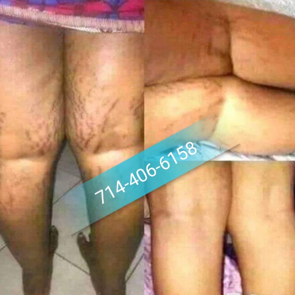 Stretch Mark - Dark Spot - Scars removed